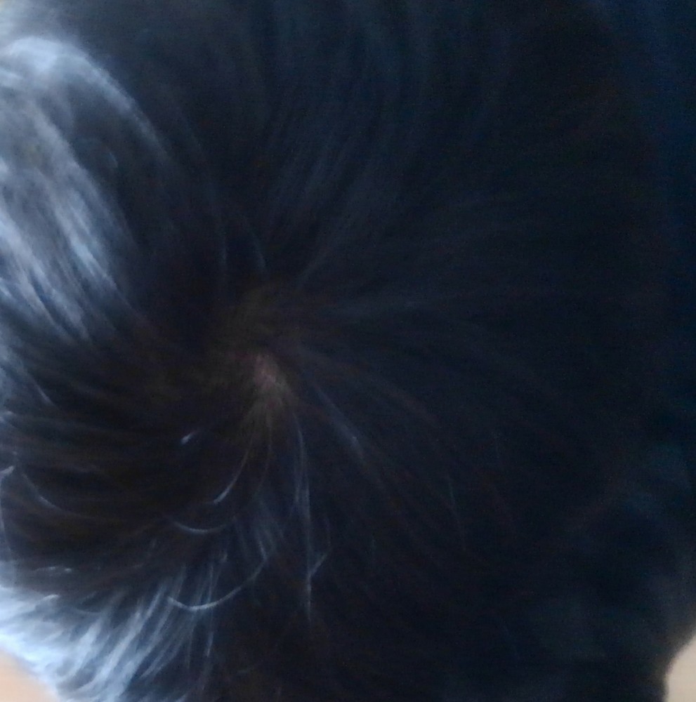 ガチでハゲてきた 助けて 	: みじかめっ！なんJ