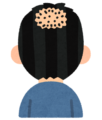 ハゲになる兆候教えろwwww: みじかめっ！なんJ