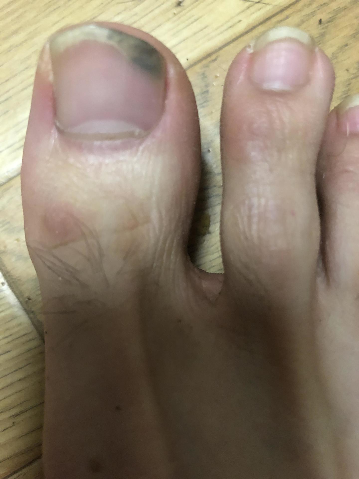 親指 足 臭い の 爪